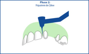 Brücke als Zahnersatz - Phase 2