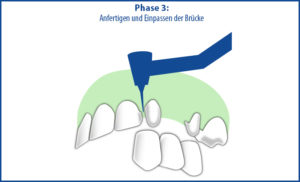 Brücke als Zahnersatz - Phase 3