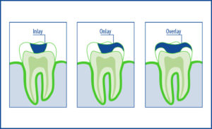 Inlay, Onlay, Overlay auf einen Blick