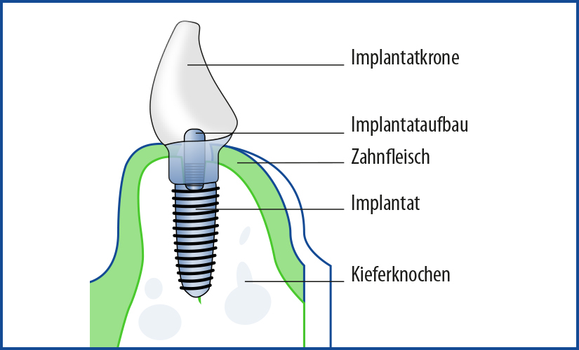 Das Implantat für den Zahnersatz wird fest im Kieferknochen verankert.