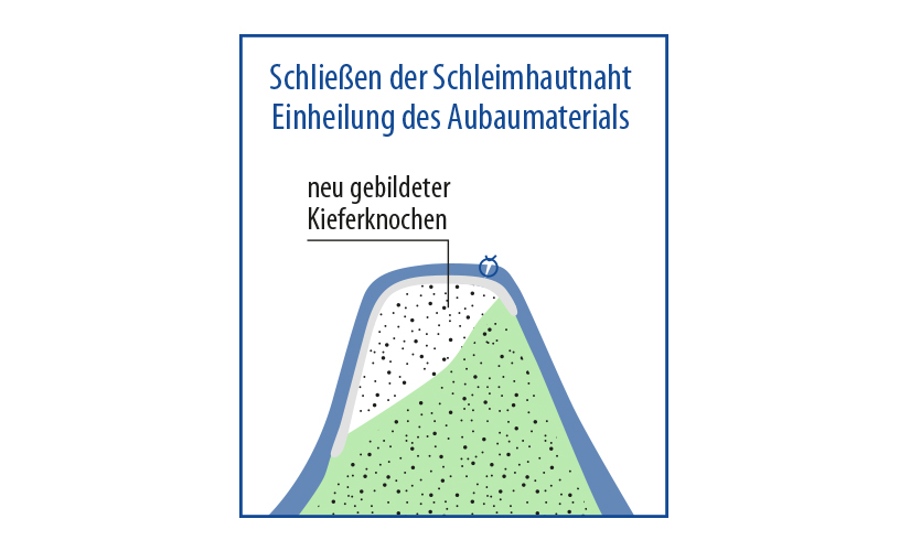 implantat knochenaufbau material code