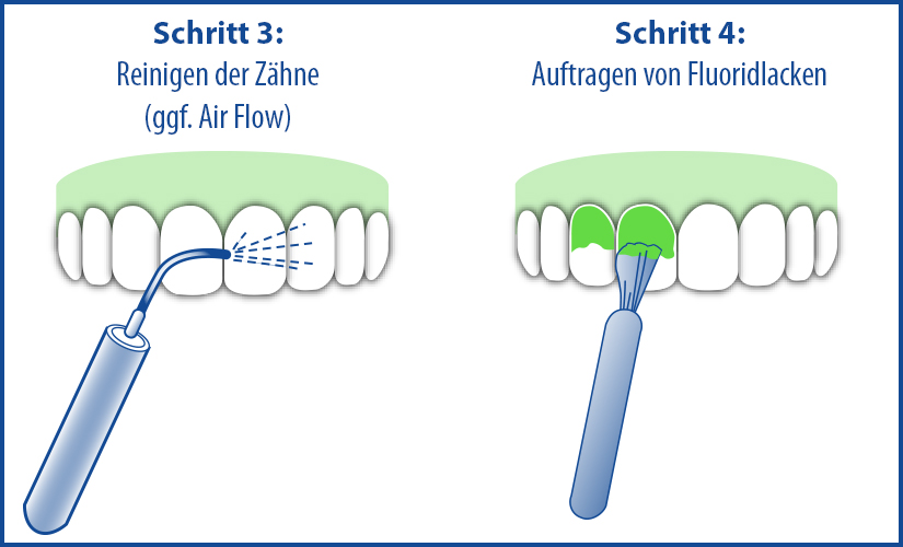 Reinigung und Schutz der Zähne bei der professionellen Zahnreinigung