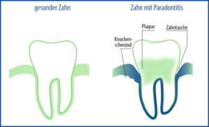 So sieht ein Zahn aus, der an Parodontose erkrankt ist.