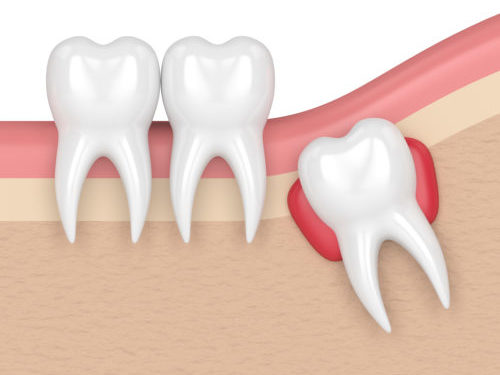 Das Bild zeigt einen Weisheitszahn mit Zyste
