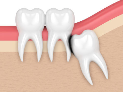 Das Bild zeigt einen verlagerten Weisheitszahn mit Karies