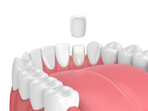So werden Verblendschalen auf Zähne aufgesetzt